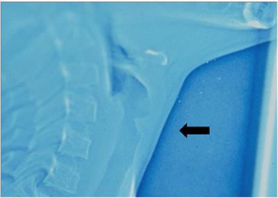 Surgical Management of Anterior Glottic Webs